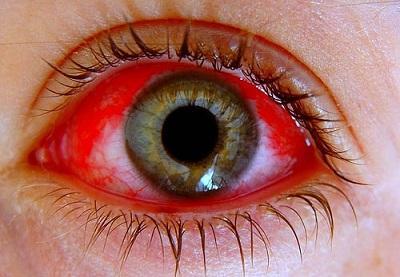 VIDEO: Denuncian epidemia de conjuntivitis en Guantánamo