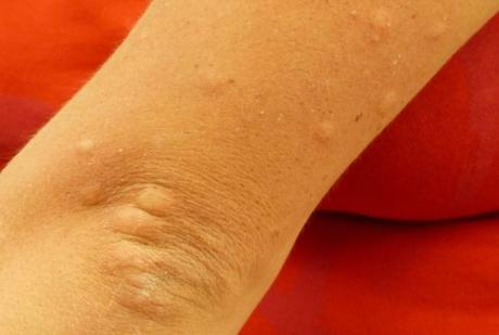 Remedios para las picaduras de insectos y de medusas