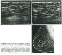 ecotectura heterogenea por ultrasonido de mama
