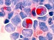 Reconocimiento signos síntomas leucemia niños