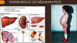 Prueban Nuevo Farmaco para tratar la Enfermedad de Niemann-Pick