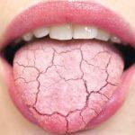 Sequedad severa de la boca después de la terapia del cáncer: remedios médicos y caseros