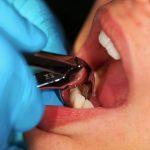Extracción de dientes después del tratamiento del cáncer: osteorradionecrosis y otras complicaciones potenciales