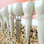 ¿Por qué mi implante dental se cae después de la radioterapia para el cáncer?