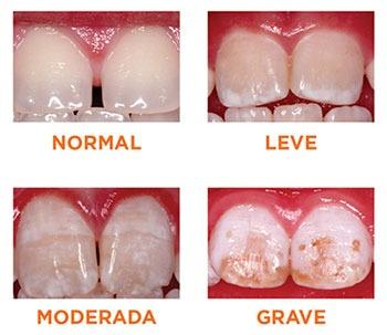 Tipos de fluorosis