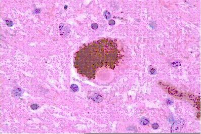 Cuerpo de Lewy clásico 