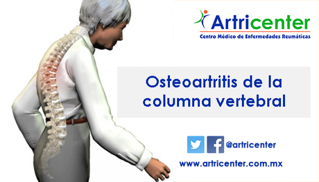 Osteoartritis de la columna vertebral