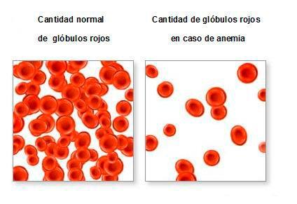 Causas de la anemia en el embarazo