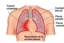 Síntomas del neumotórax