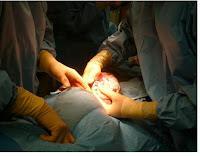 Todo sobre la anestesia epidural en la cesárea [4]