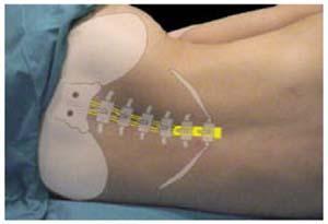 Todo sobre la anestesia epidural en la cesárea [3]