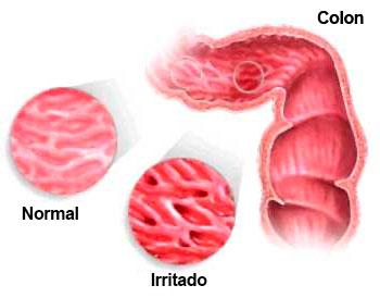 Causas del colon irritable