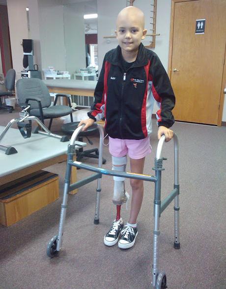 Chica de 15 años perdió su pierna pero sigue bailando un caso de Motivacion increible