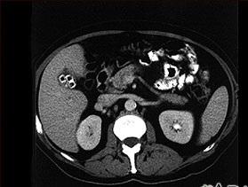 COLECISTITIS