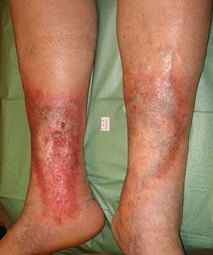 El Mejor Tratamiento No Quirúrgico para las Ulceras Varicosas