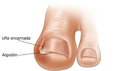 Resultado de imagen para algodon para las uñas