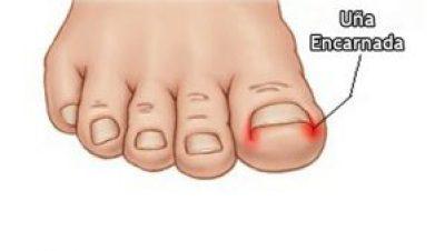 Mira como extraer una uña encarnada si sentir dolor alguno