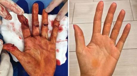 El antes y después de la mano de una tenista rusa atacada con cuchillo