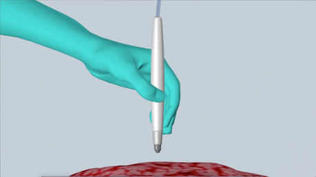 Dispositivo identifica con precisión el cáncer en segundos