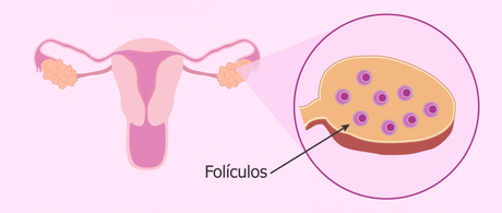ovarios poliquísticos