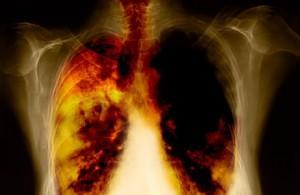 4th-Stage-Of-Lung-Cancer Nuevos avances en tratamientos contra el cáncer de pulmón