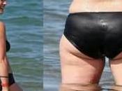 celulitis síndrome acordeón