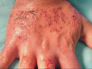 Dermatitis