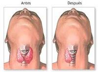 La Tiroidectomia Mejora la calidad de vida en pacientes con Bócio
