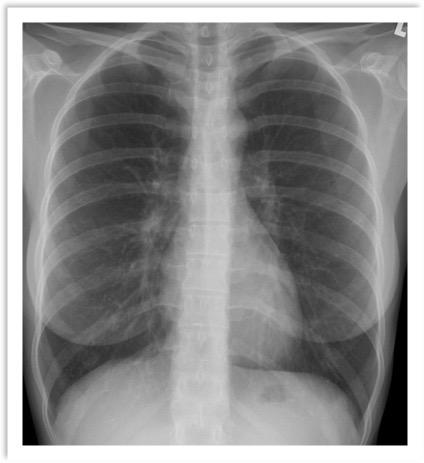 TÉCNICA RADIOLOGICA PARA    LA PLACA POSTERO ANTETIOR DE TÓRAX