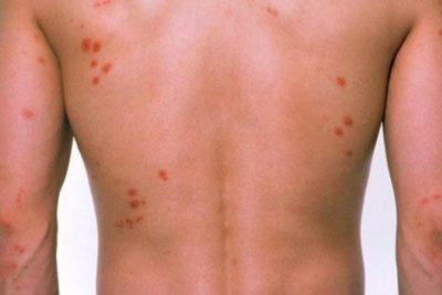 ¿Cómo deshacerse de las chinches de cama?