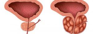 La prostatitis no siempre es obvia Opciones de tratamiento para la hiperplasia prostática benigna (HPB)
