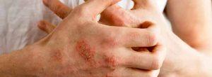 Remedios caseros para la dermatitis y el eczema