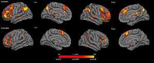 ¿Sabías cómo actúan las 3 drogas más consumidas en España sobre nuestro cerebro?