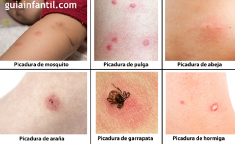 Cómo reconocer las picaduras de diferentes tipos de insectos y qué hacer ante cada una Cómo reconocer las picaduras de diferentes tipos de insectos y qué hacer ante cada una