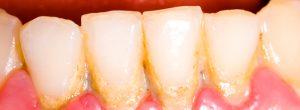 Tratamiento para la piorrea de las encías (Periodontitis)