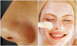 ¡Elimina los puntos negros ahora! Con esta Fácil y efectiva mascarilla… ¡Elimina los puntos negros ahora! Con esta Fácil y efectiva mascarilla…