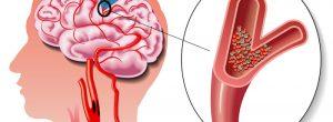 ¿Cómo reconocer un accidente cerebrovascular?