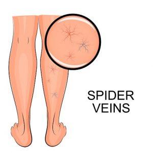 ¿Qué tipos de lesiones vasculares existen? ¿Cuál es la tuya? tipos lesiones vasculares