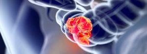 ¿Puede la aspirina detener el cáncer de hígado en pacientes con hepatitis B? Se descubrió una nueva droga contra el cáncer intestinal