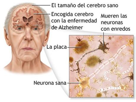 ¿Se puede prevenir naturalmente el alzhéimer?