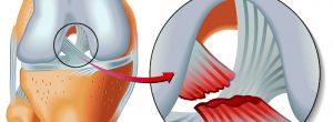 Lesión del ligamento cruzado: causas, síntomas, cirugía y tiempo de recuperación de LCA