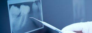 Comparando el costo de las opciones de reemplazo de dientes permanentes: implantes dentales, coronas y puentes