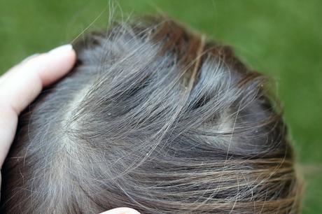 Cómo eliminar piojos y liendres de forma rápida Cómo eliminar piojos y liendres de forma rápida