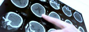 Hidrocefalia: el agua en el cerebro