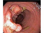 Cáncer colorrectal anciano. Tratamiento quirúrgico, quimioterápico aportación desde geriatría.