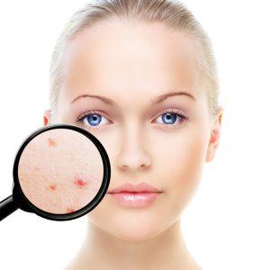 clinica para eliminar cicatrices del acne madrid