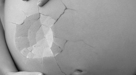 Microdermoabrasión para las estrías Microdermoabrasión para las estrías