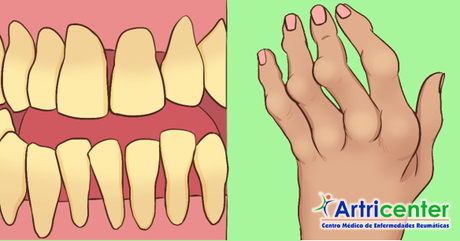 Artritis reumatoide y enfermedad de las encías