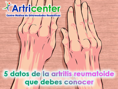 5 datos de la artritis reumatoide que debes conocer