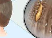 Pediculosis; Piojos Liendres